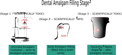 Dental Amalgam Filling Stages clipart