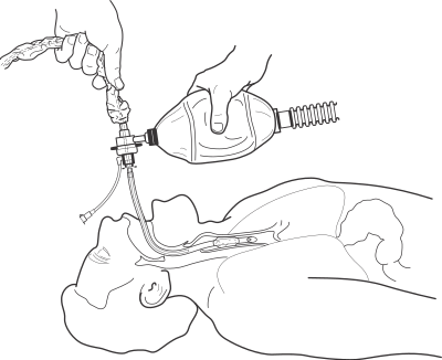 Endotracheal Procedure clipart
