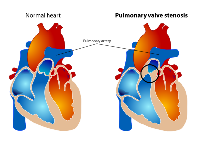 Pulmonary valve stenosis clipart